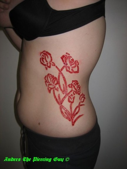 Tattoos - Anders Allinger - Skin Removal