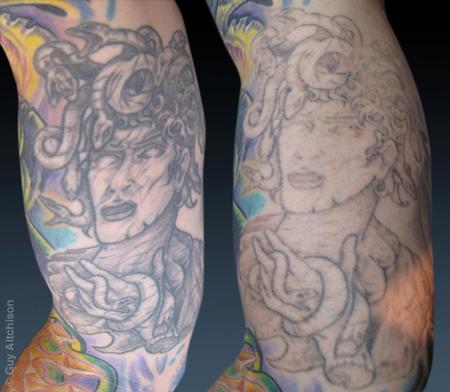 Tattoos - Don, before and after several laser sessions - 71527