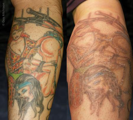 Tattoos - Hiro, before lasering - 71544