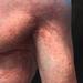 tattoo galleries/ - Kevin, massive electrical burn scar, before - 71538