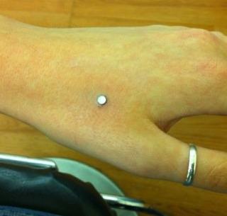 Gina - Hand Dermal