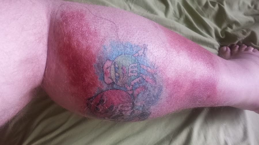 Is This Tattoo Healing Properly I Have A Bunch Of Other Tattoos But None Turned Red And Swollen Like This One It Is Warm To The Touch And Very Swollen Raised I Got