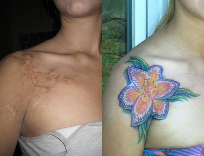 Es Malo Tatuarse Sobre Las Cicatrices El Arte De La Piel