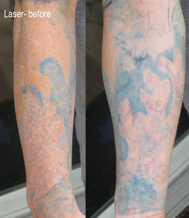 Tattoo Removal Before And After Sleeve Laser tattoo removal and