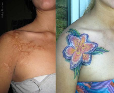 Tattoos - Nicole, childhood coffee burn scar, before and after - 71537