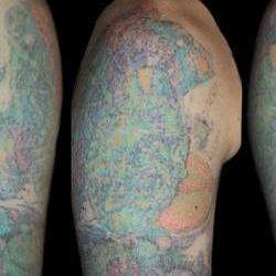 Tattoos - David, after 6 laser sessions  - 71524