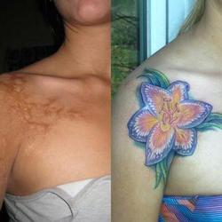 Tattoos - Nicole, childhood coffee burn scar, before and after - 71537